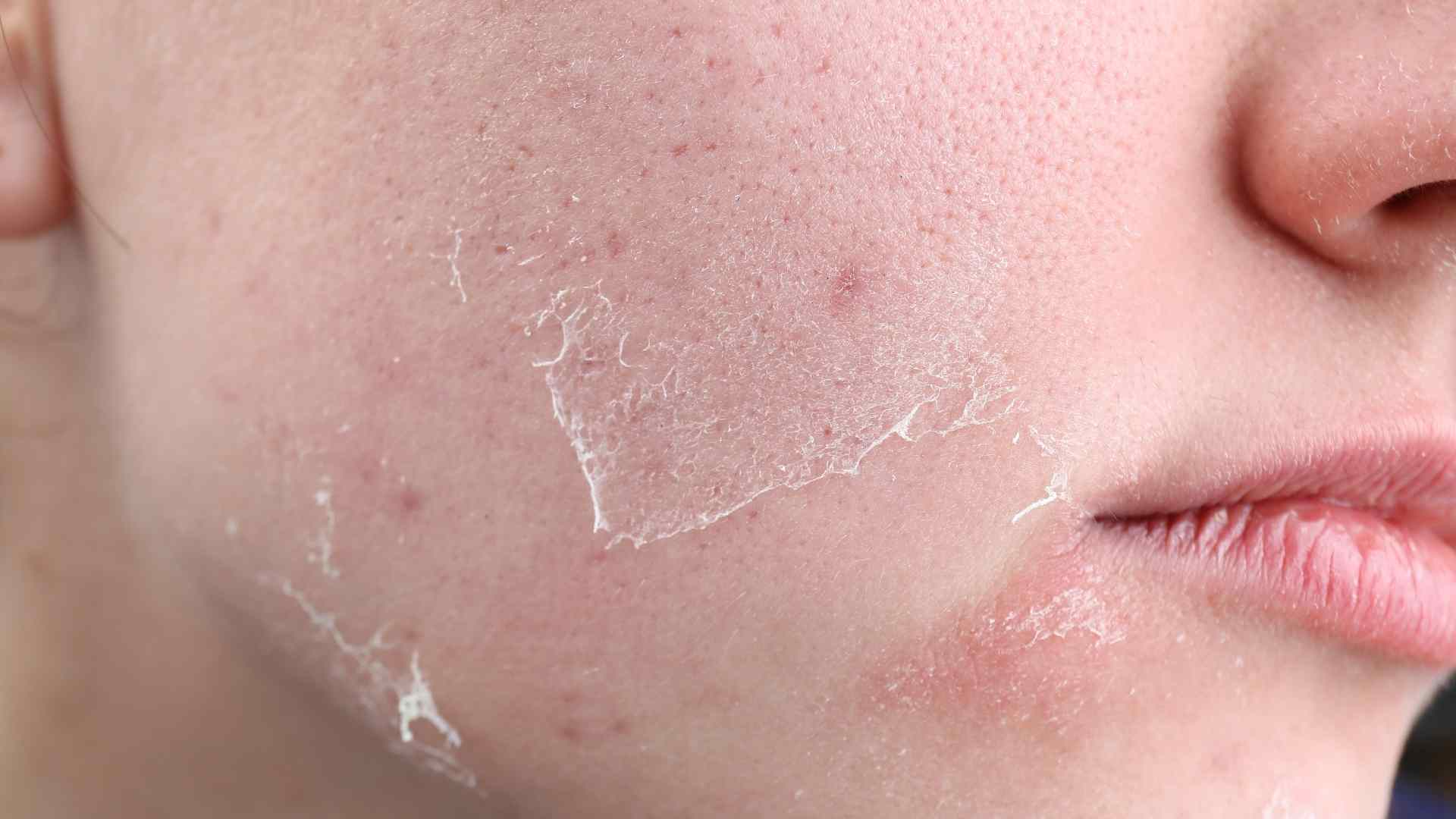 Da khô nứt nẻ do không khí khô hanh 