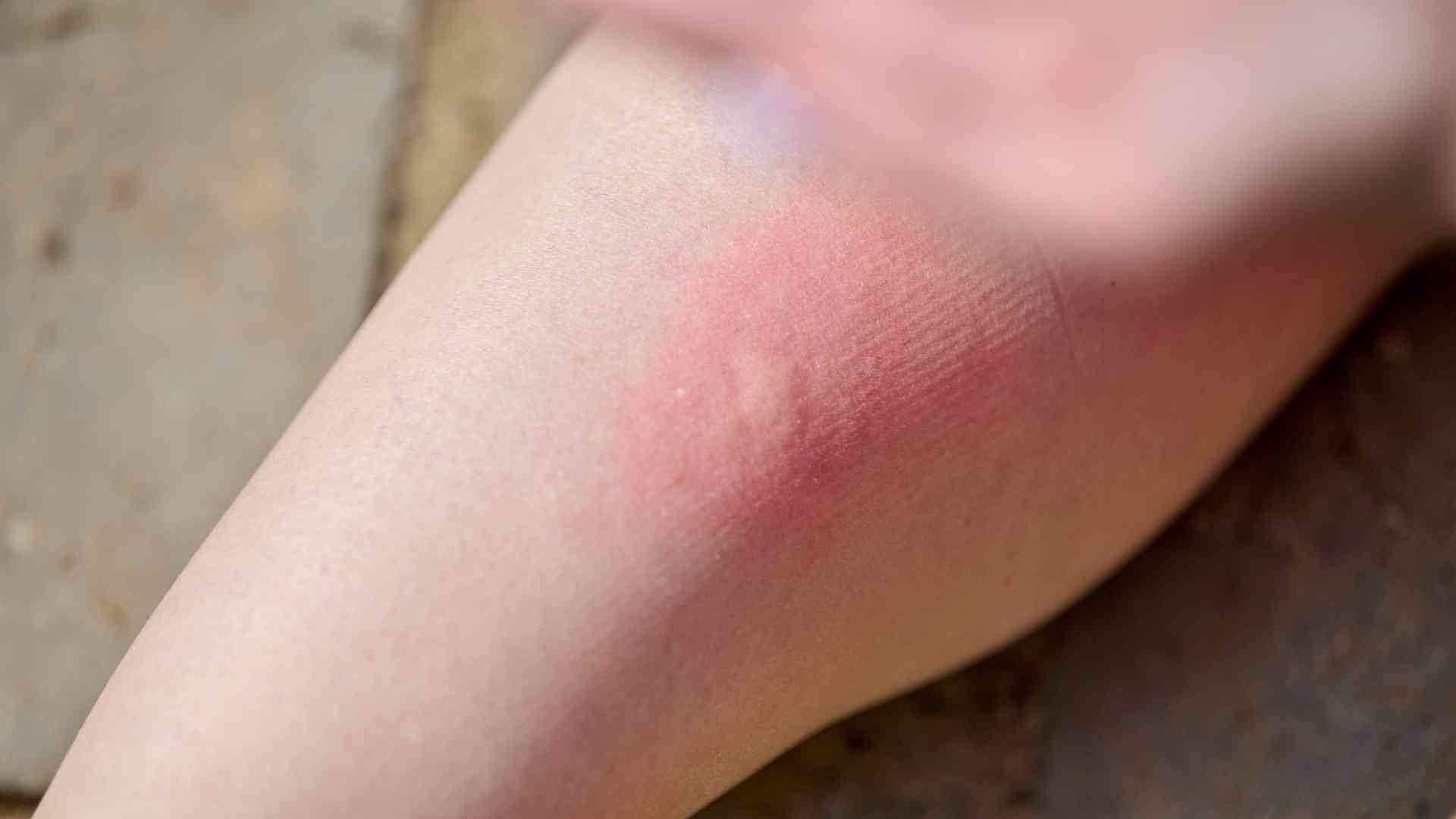 Kích ứng da và mắt khí tiếp xúc nhiều khói bụi từ phương tiện giao thông